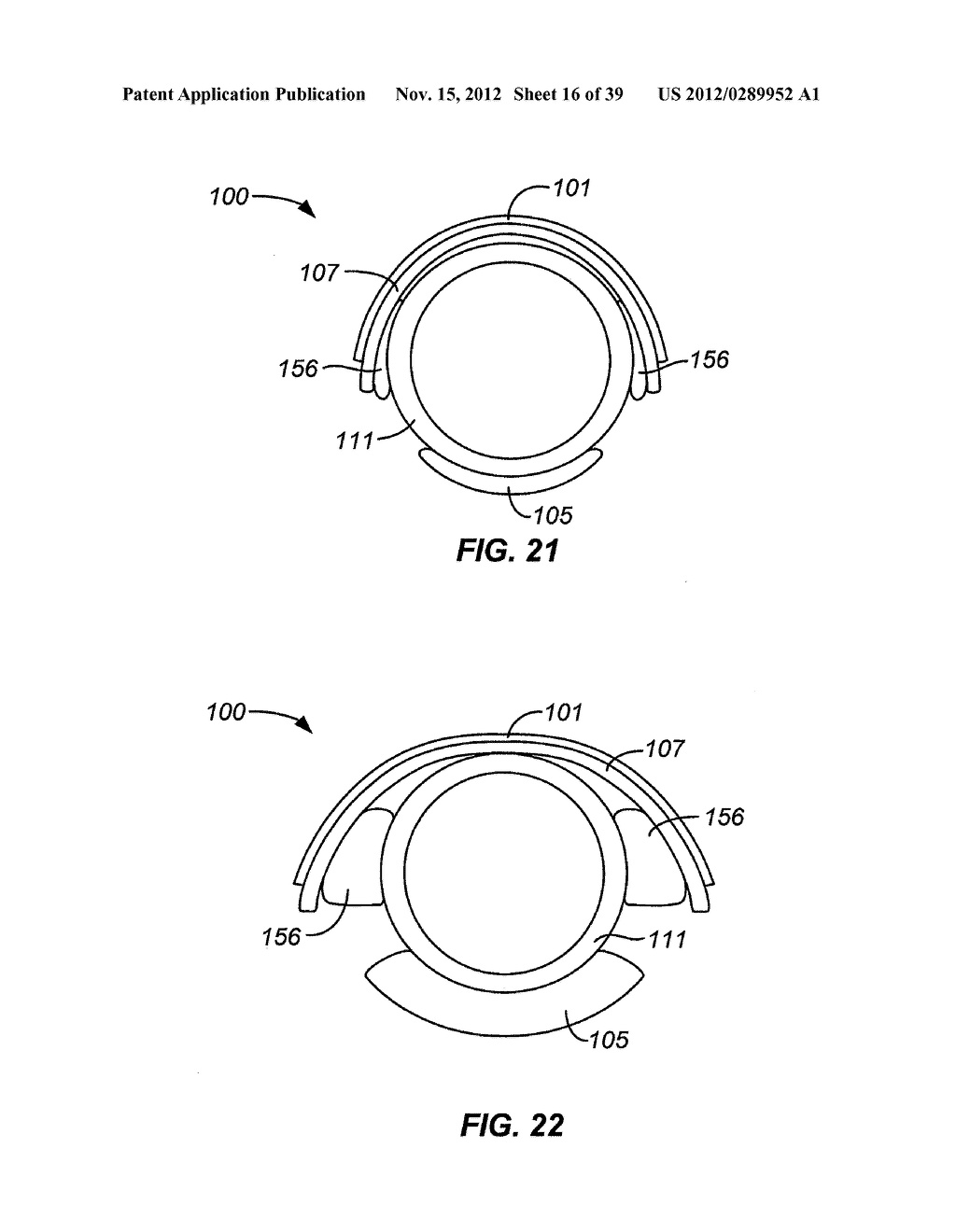 METHOD AND APPARATUS FOR GASTROINTESTINAL TRACT ABLATION TO ACHIEVE LOSS     OF PERSISTENT AND/OR RECURRENT EXCESS BODY WEIGHT FOLLOWING A WEIGHT LOSS     OPERATION - diagram, schematic, and image 17