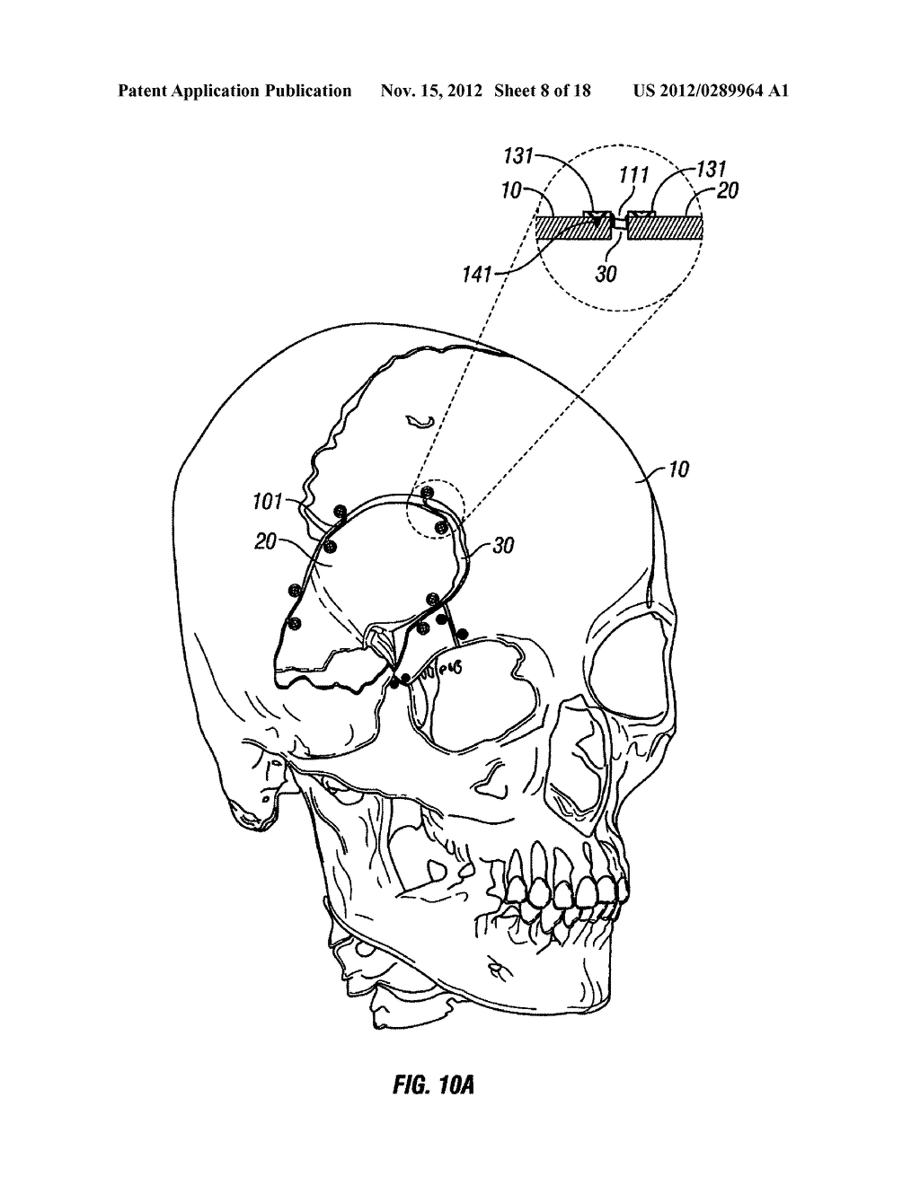 CRANIAL PLATING AND BUR HOLE COVER SYSTEM AND METHODS OF USE - diagram, schematic, and image 09