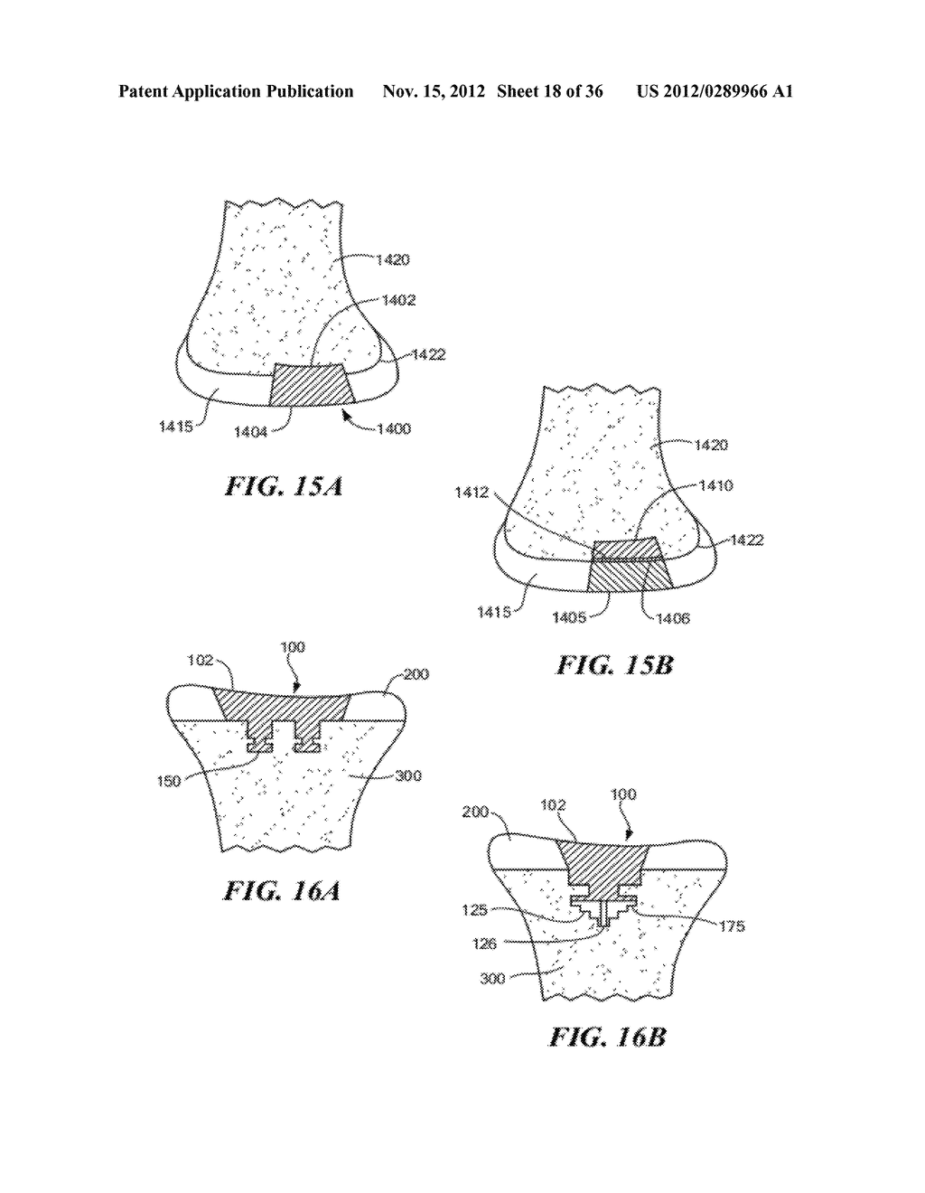 JOINT ARTHROPLASTY DEVICES AND SURGICAL TOOLS - diagram, schematic, and image 19