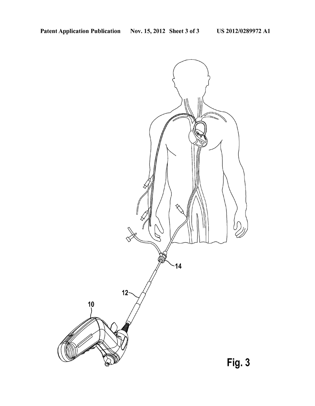 HANDHELD DEVICE FOR STENT IMPLANTATION - diagram, schematic, and image 04