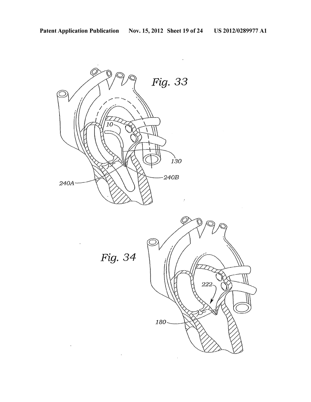 MITRAL VALVE REPAIR SYSTEM AND METHOD FOR USE - diagram, schematic, and image 20