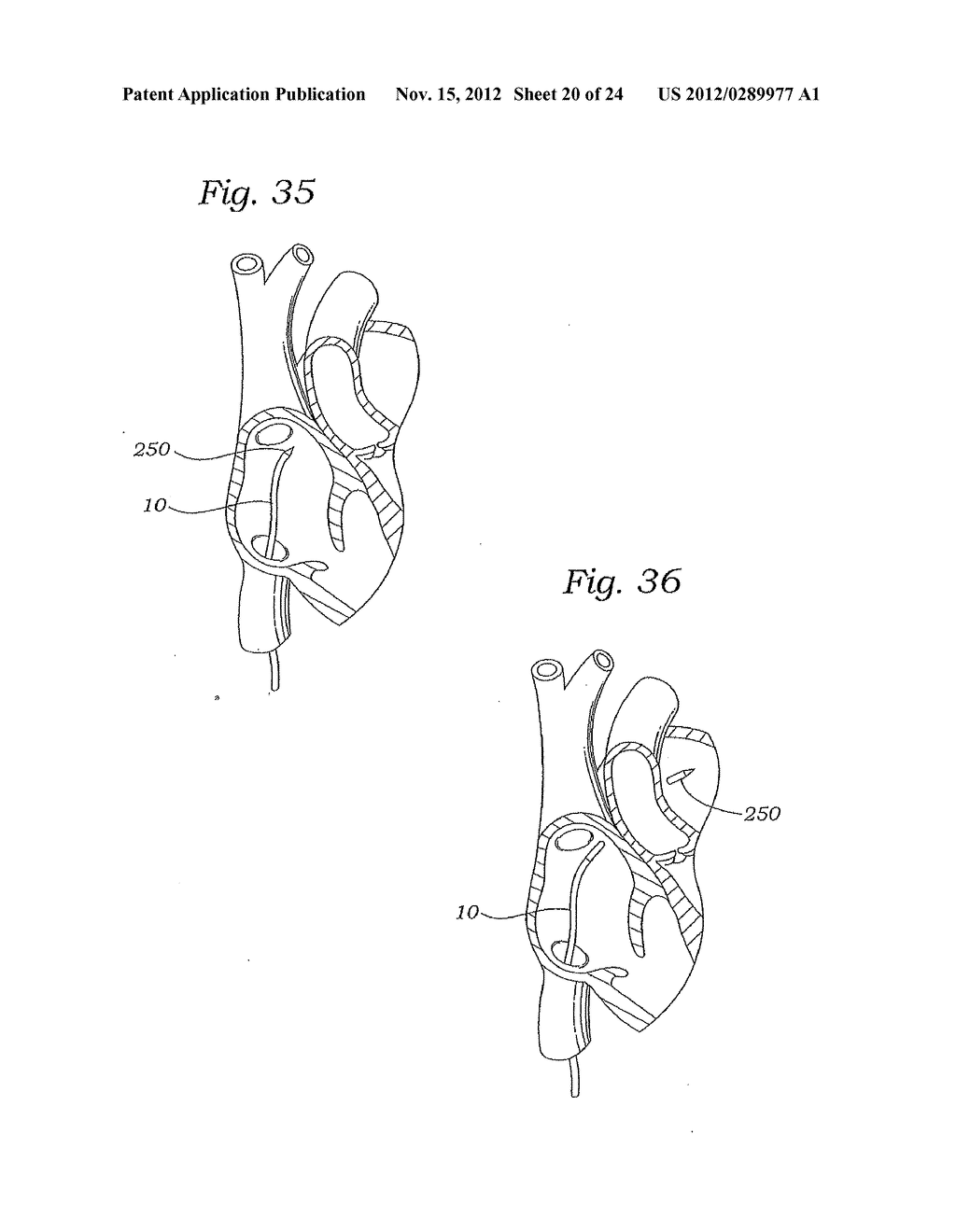 MITRAL VALVE REPAIR SYSTEM AND METHOD FOR USE - diagram, schematic, and image 21