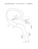 METHODS AND DEVICES FOR RECANALIZATION OF OCCLUDED BODY VESSELS USING A     DOUBLE-SIDED GUIDEWIRE diagram and image