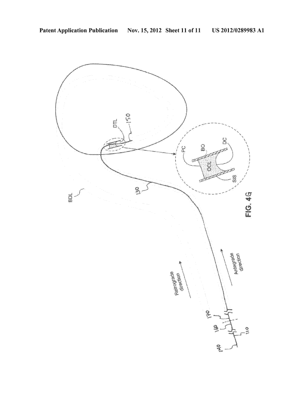 METHODS AND DEVICES FOR RECANALIZATION OF OCCLUDED BODY VESSELS USING A     DOUBLE-SIDED GUIDEWIRE - diagram, schematic, and image 12