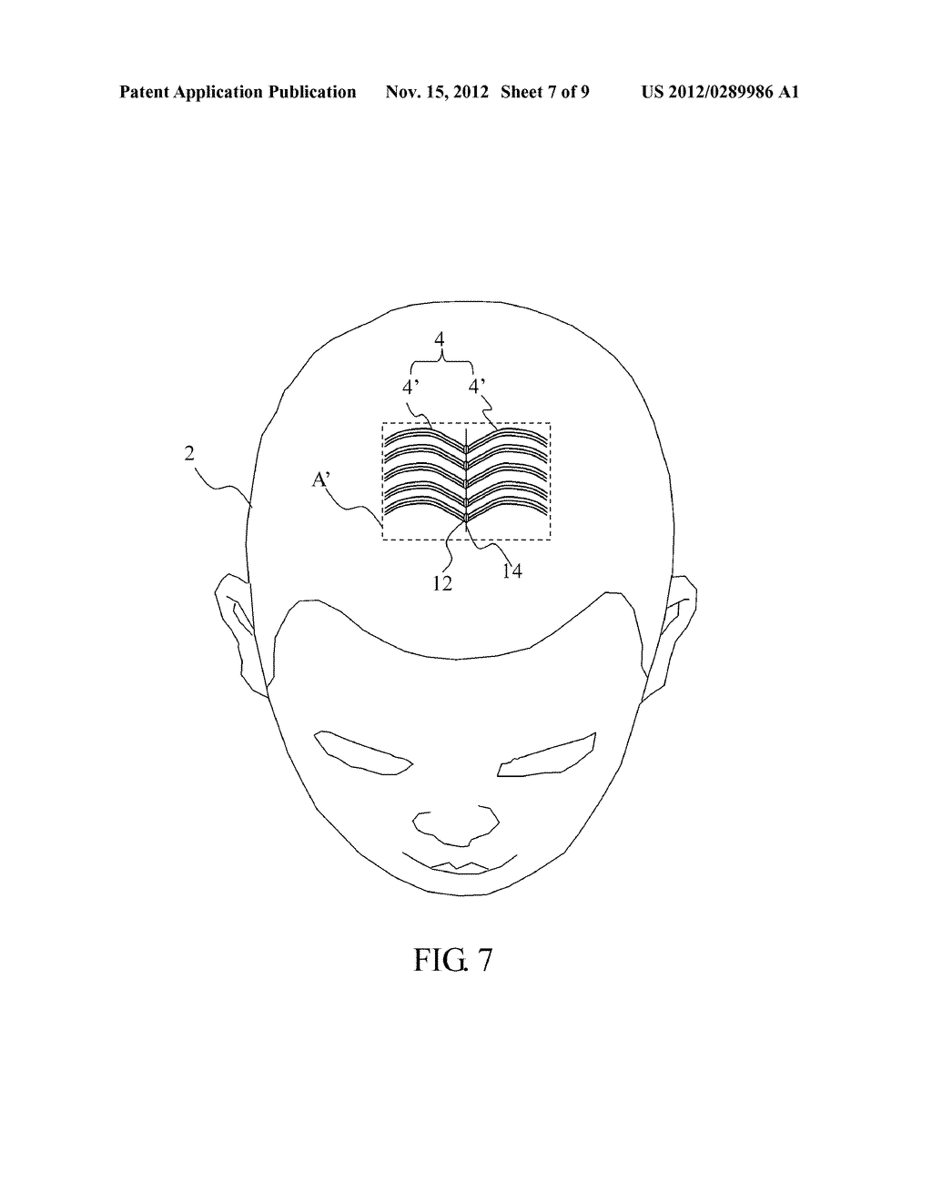 ARTIFICIAL HAIR TRANSPLANTATION METHOD - diagram, schematic, and image 08