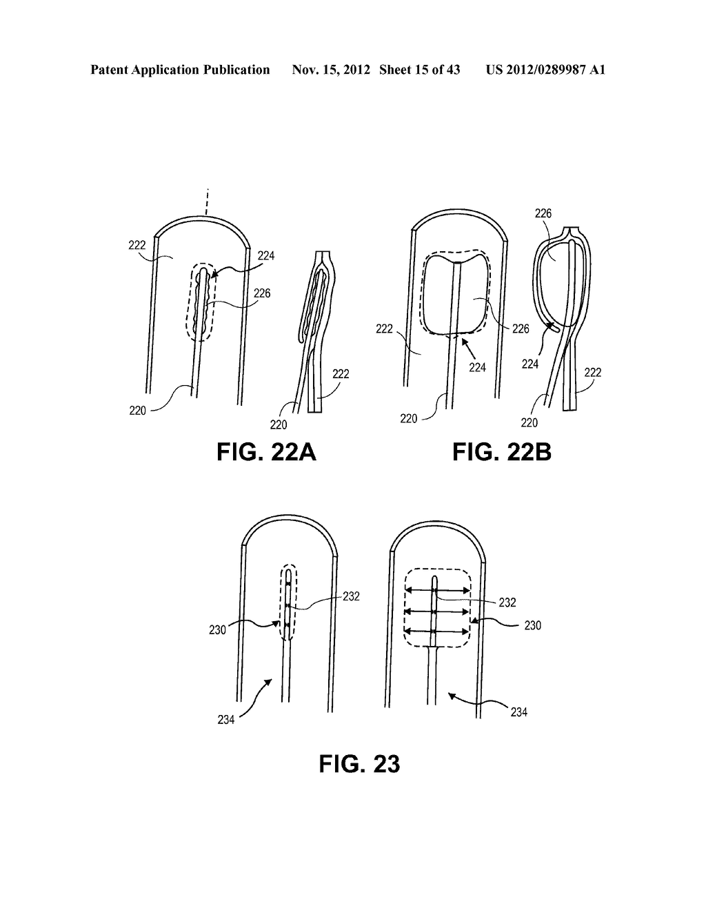 SYSTEMS AND METHODS FOR ENDOLUMINAL VALVE CREATION - diagram, schematic, and image 16