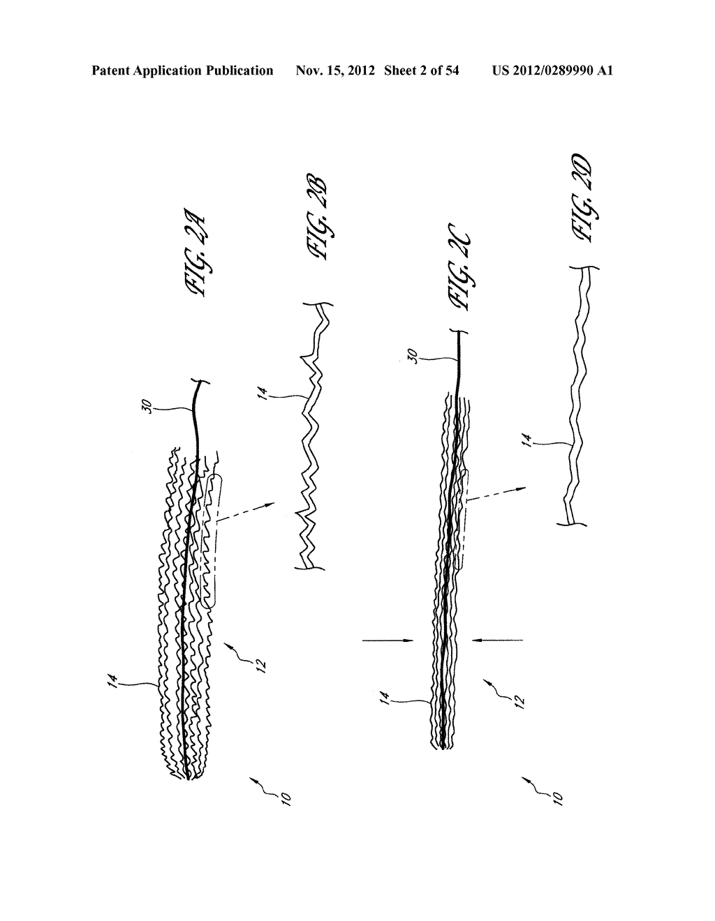 STRUCTURES FOR PERMANENT OCCLUSION OF A HOLLOW ANATOMICAL STRUCTURE - diagram, schematic, and image 03