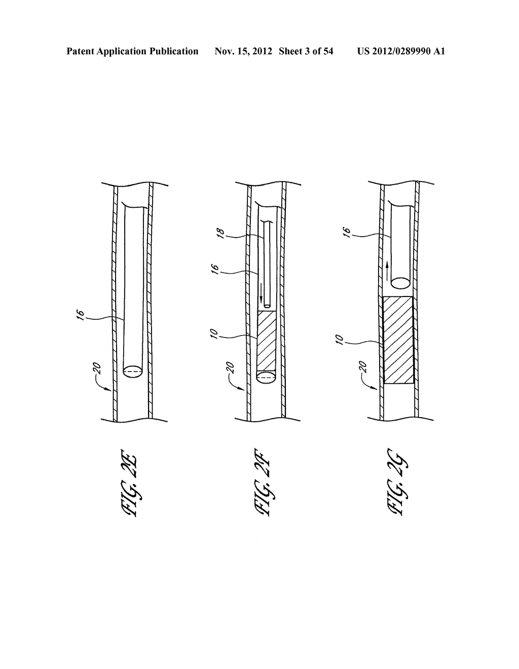 STRUCTURES FOR PERMANENT OCCLUSION OF A HOLLOW ANATOMICAL STRUCTURE - diagram, schematic, and image 04