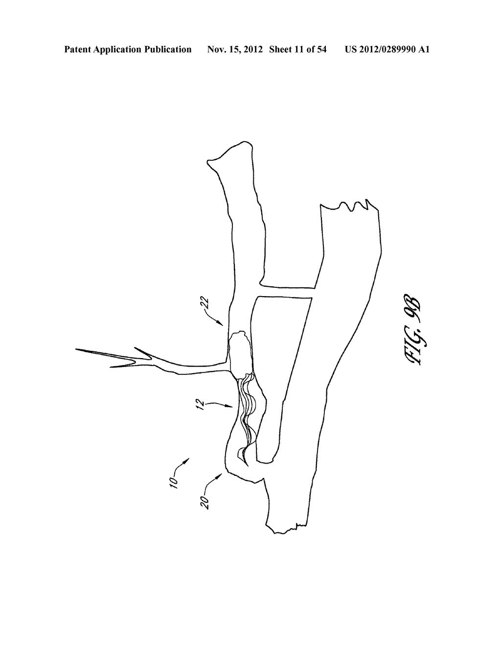 STRUCTURES FOR PERMANENT OCCLUSION OF A HOLLOW ANATOMICAL STRUCTURE - diagram, schematic, and image 12