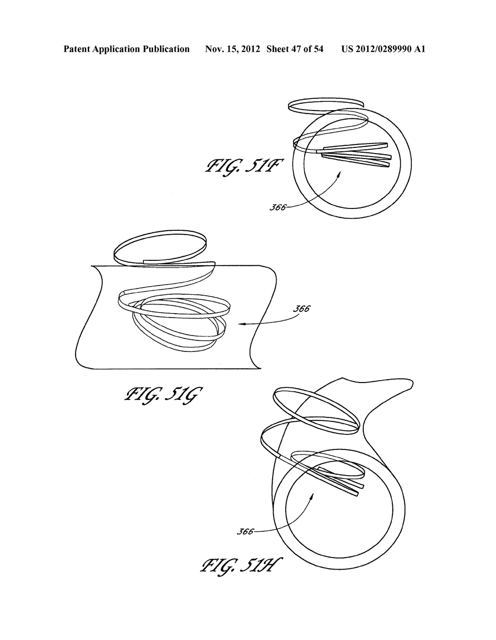 STRUCTURES FOR PERMANENT OCCLUSION OF A HOLLOW ANATOMICAL STRUCTURE - diagram, schematic, and image 48