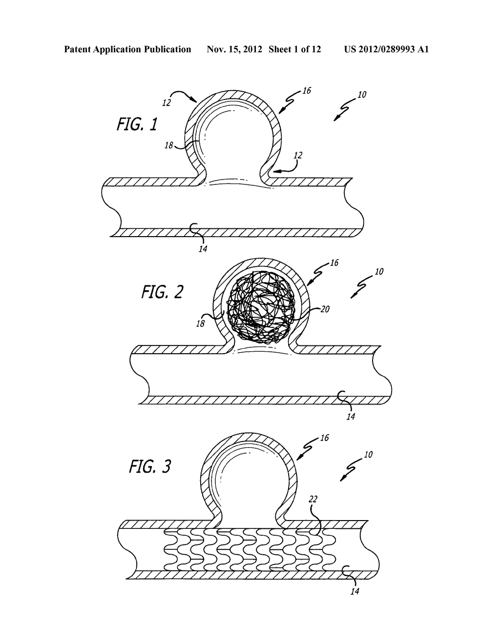Aneurysm Treatment Device And Method Of Use - diagram, schematic, and image 02