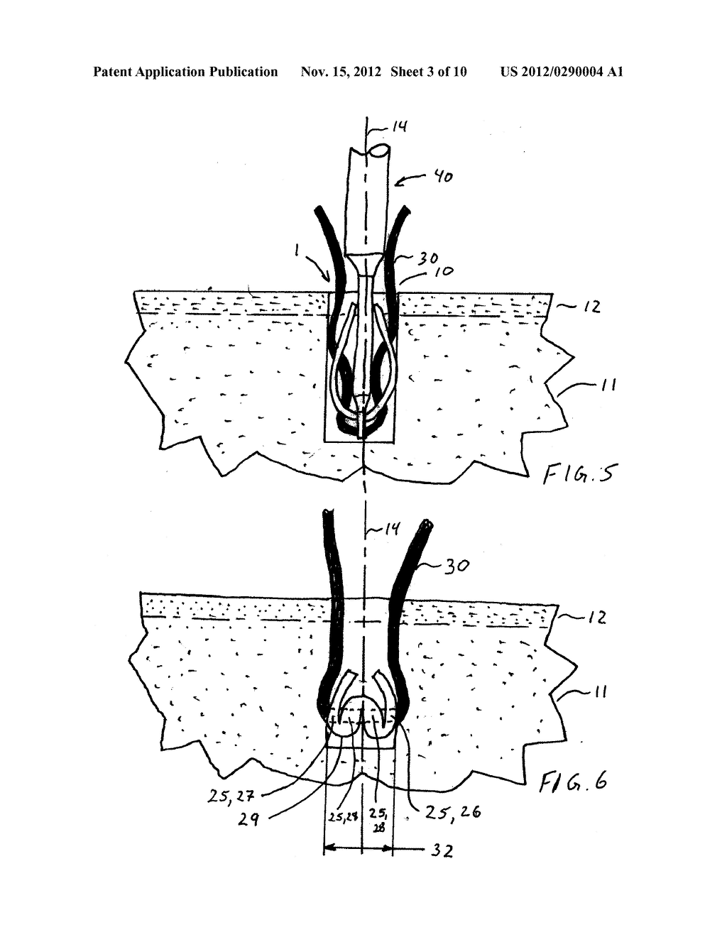 SOFT ANCHOR MADE FROM SUTURE FILAMENT AND SUTURE TAPE - diagram, schematic, and image 04