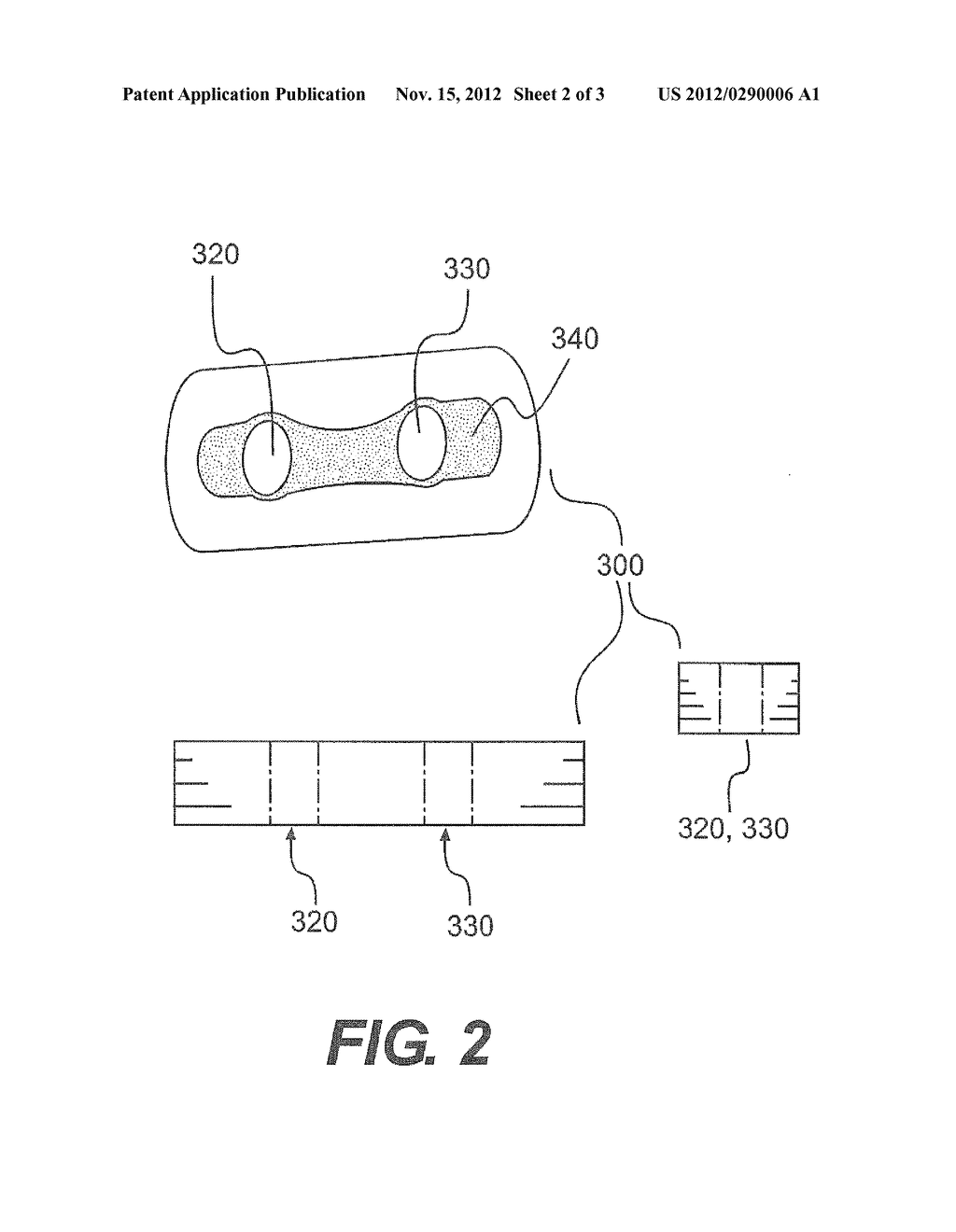 Adjustable Suture Lock Loop - diagram, schematic, and image 03