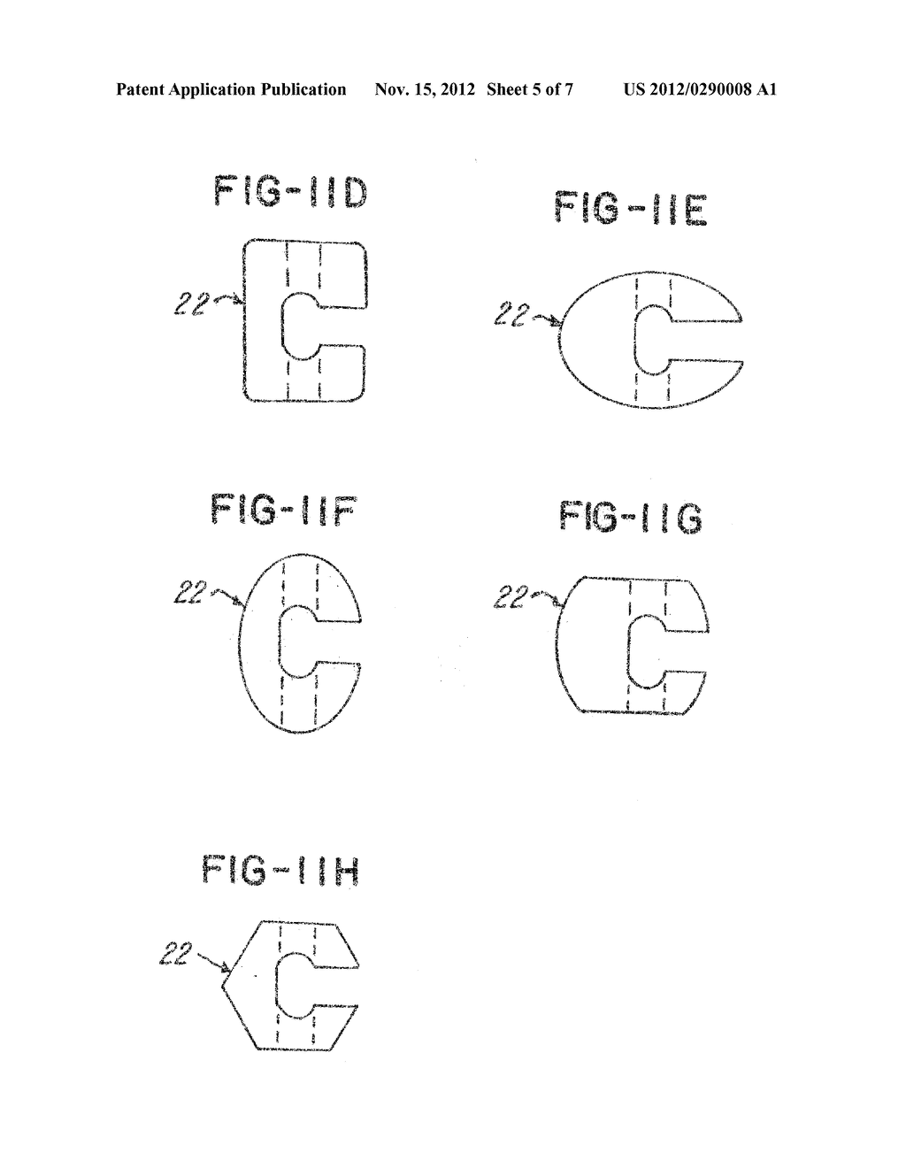 MODULAR INTERSPINOUS FIXATION SYSTEM AND METHOD - diagram, schematic, and image 06