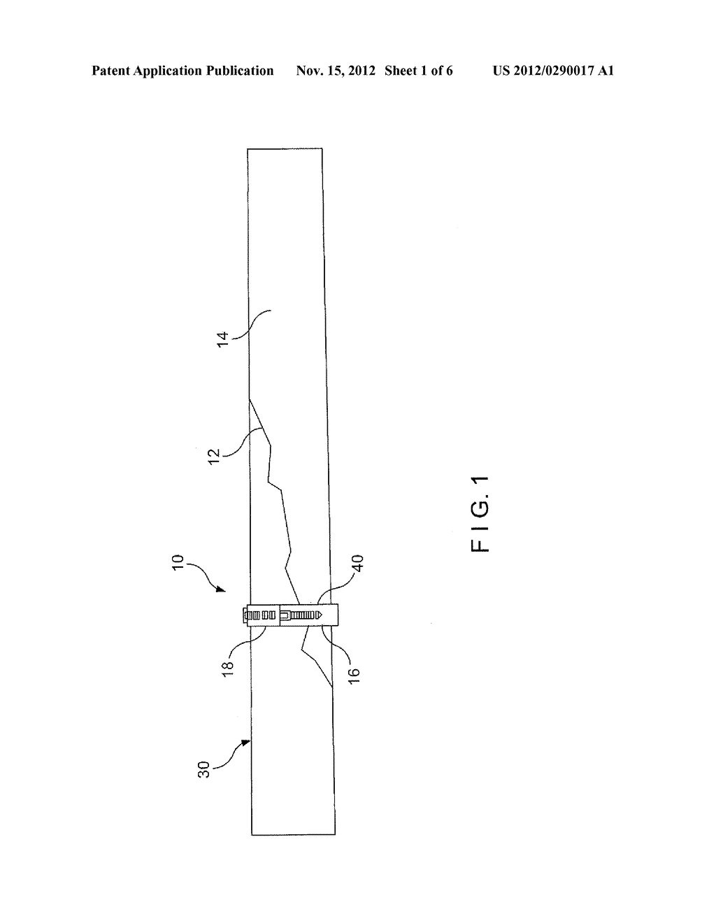 Bone fracture fixation clamp - diagram, schematic, and image 02