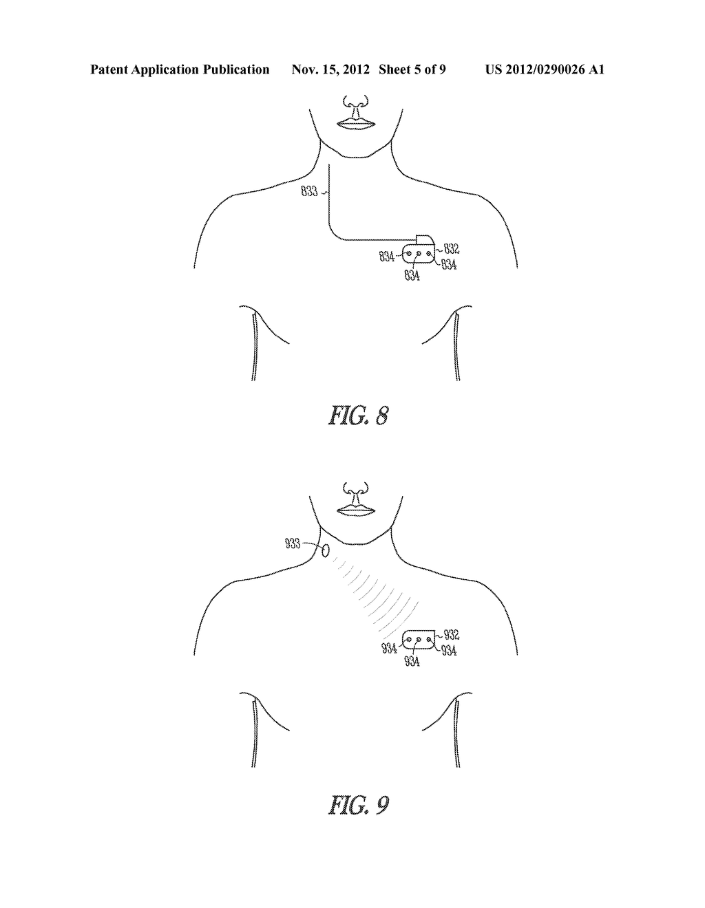 SYSTEMS AND METHODS FOR TREATING SUPRAVENTRICULAR ARRHYTHMIAS - diagram, schematic, and image 06