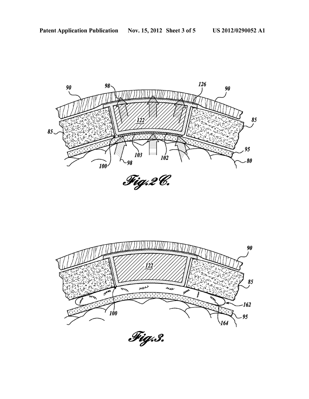 METHODS AND DEVICES FOR BRAIN COOLING FOR TREATMENT AND/OR PREVENTION OF     EPILEPTIC SEIZURES - diagram, schematic, and image 04