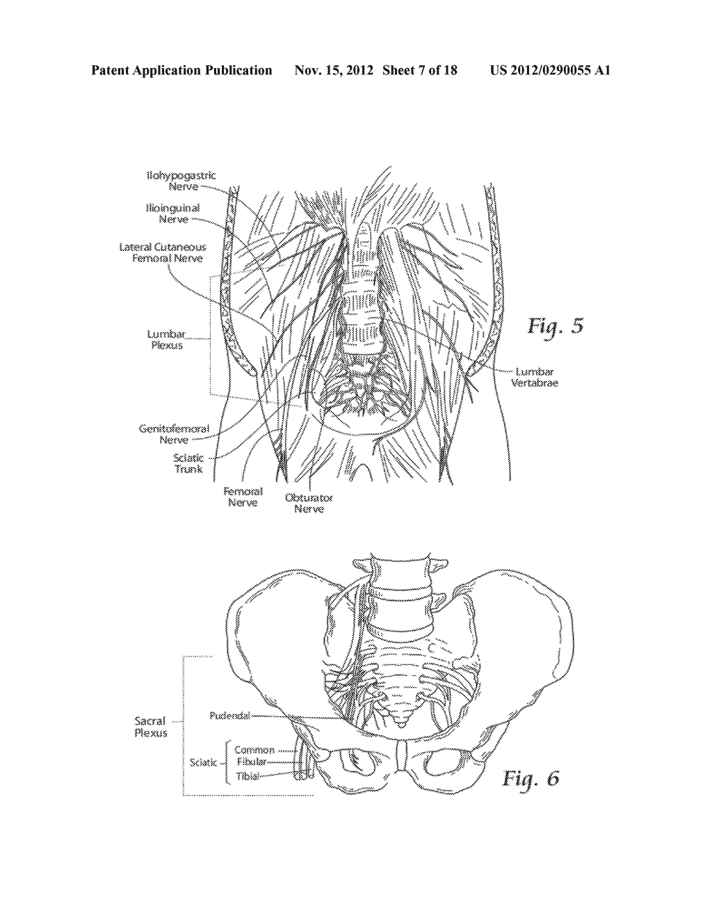 SYSTEMS AND METHODS TO PLACE ONE OR MORE LEADS IN TISSUE TO ELECTRICALLY     STIMULATE NERVES TO TREAT PAIN - diagram, schematic, and image 08