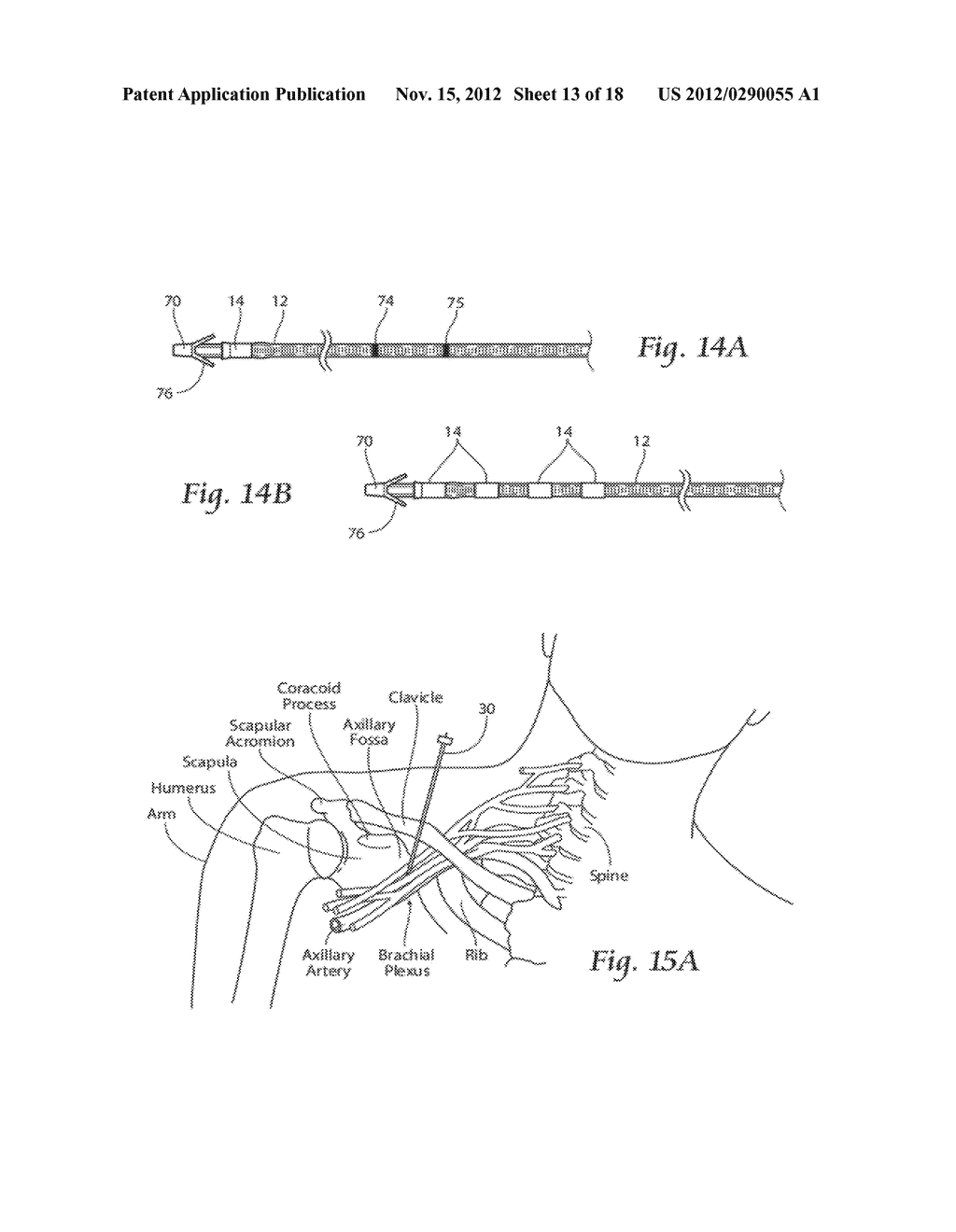 SYSTEMS AND METHODS TO PLACE ONE OR MORE LEADS IN TISSUE TO ELECTRICALLY     STIMULATE NERVES TO TREAT PAIN - diagram, schematic, and image 14