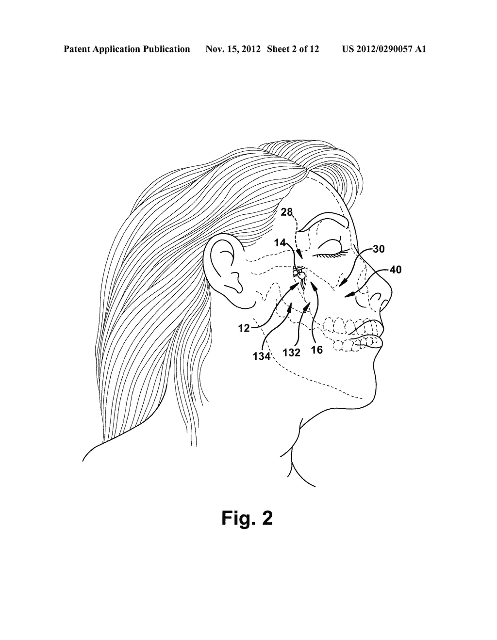 APPARATUS AND METHOD FOR DELIVERING A NEUROSTIMULATOR INTO THE     PTERYGOPALATINE FOSSA - diagram, schematic, and image 03