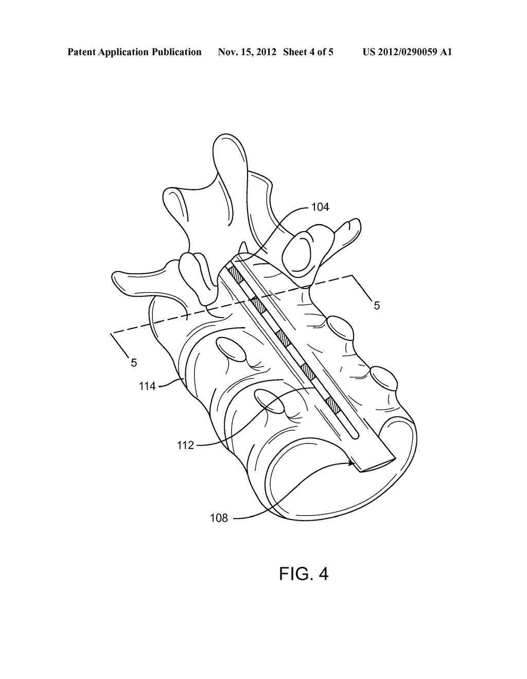 SYSTEM AND METHOD FOR ELECTRICAL MODULATION OF THE POSTERIOR LONGITUDINAL     LIGAMENT - diagram, schematic, and image 05