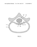 SYSTEM AND METHOD FOR ELECTRICAL MODULATION OF THE POSTERIOR LONGITUDINAL     LIGAMENT diagram and image