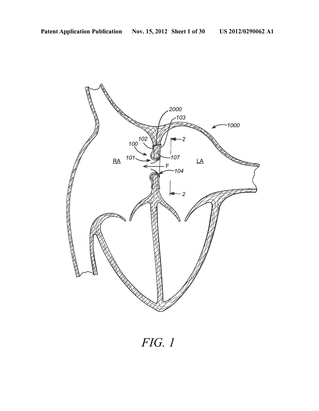 INTRA-ATRIAL IMPLANTS MADE OF NON-BRAIDED MATERIAL - diagram, schematic, and image 02