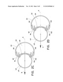 STEERABLE ILIAC BRANCH DEVICE diagram and image