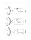 TISSUE RESTRAINING DEVICES AND METHODS OF USE diagram and image