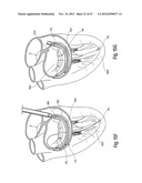 TISSUE RESTRAINING DEVICES AND METHODS OF USE diagram and image