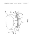 TISSUE RESTRAINING DEVICES AND METHODS OF USE diagram and image