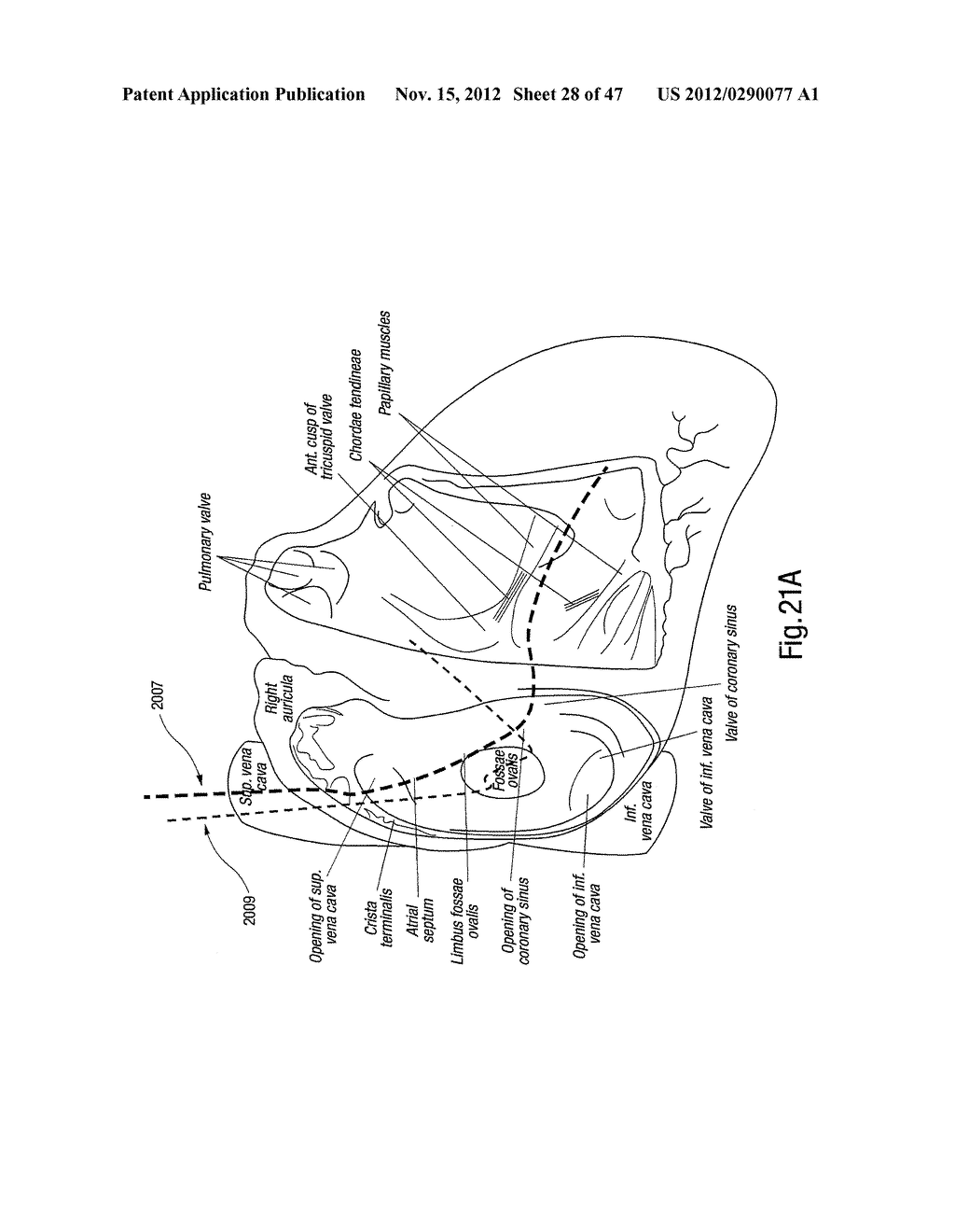 TISSUE RESTRAINING DEVICES AND METHODS OF USE - diagram, schematic, and image 29