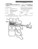 SPINAL IMPLANTS diagram and image