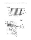 SPINAL IMPLANTS diagram and image