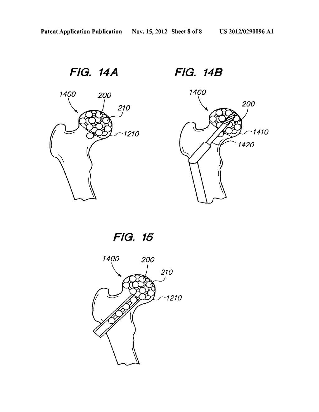 FLEXIBLE ELONGATED CHAIN IMPLANT AND METHOD OF SUPPORTING BODY TISSUE WITH     SAME - diagram, schematic, and image 09