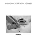 MINIMALLY INVASIVE SURGICAL TOOLS FOR HIP PROSTHESIS diagram and image