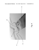 HIGH-K METAL GATE DEVICE diagram and image