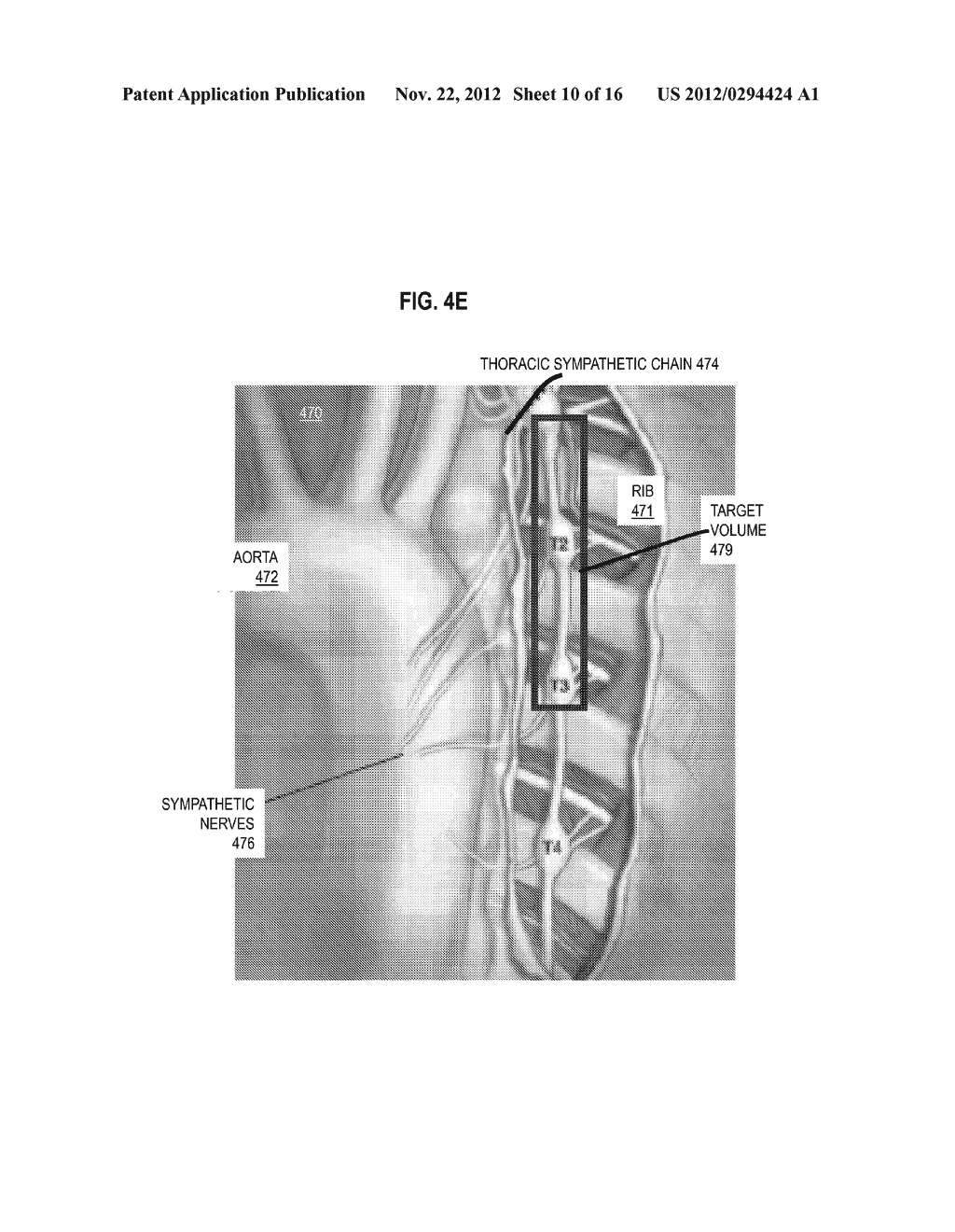 Method And Apparatus for Radioablation of Regular Targets such as     Sympathetic Nerves - diagram, schematic, and image 11