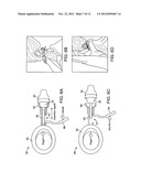 Tool For Insertion and Removal of In-Canal Hearing Devices diagram and image