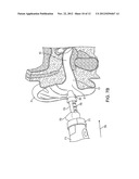 Tool For Insertion and Removal of In-Canal Hearing Devices diagram and image