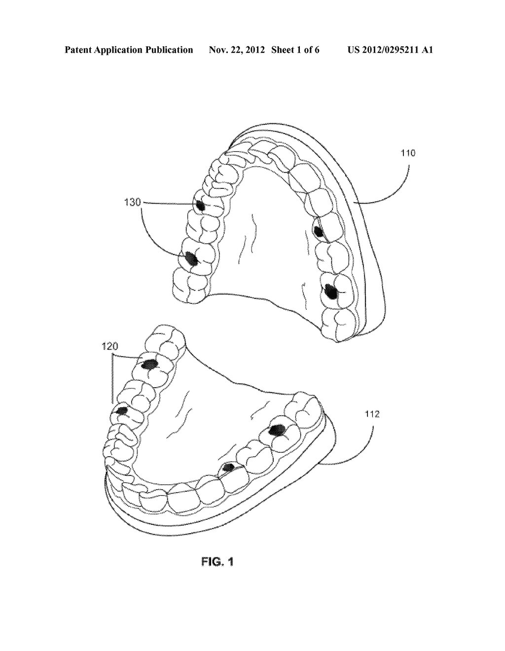 Method and Apparatus for Vacuum-Formed Dental Appliance - diagram, schematic, and image 02