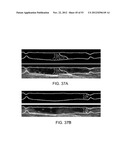 METHODS OF CONTROLLING MAGNETIC NANOPARTICLES TO IMPROVE VASCULAR FLOW diagram and image