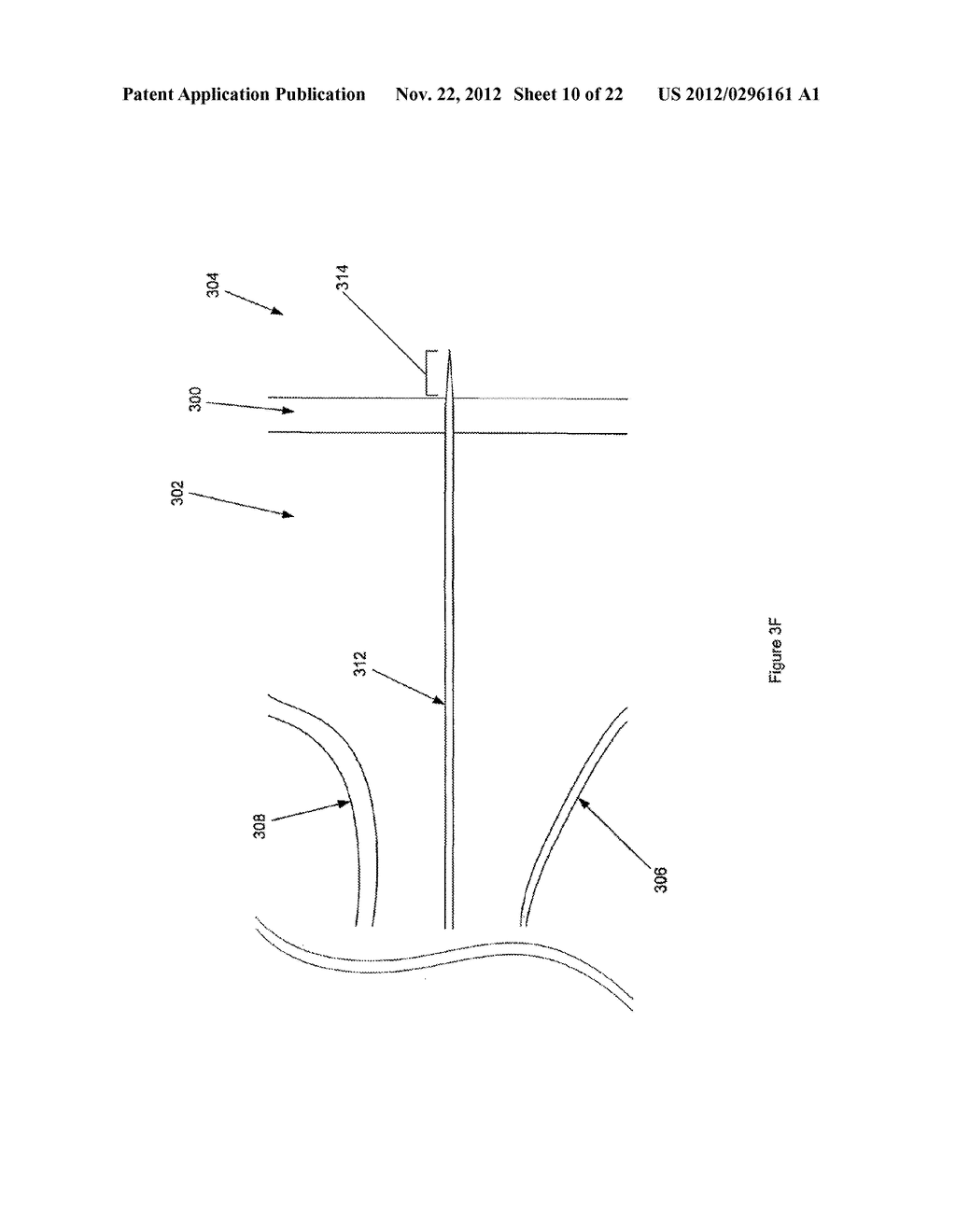 BALLOON VISUALIZATION FOR TRAVERSING A TISSUE WALL - diagram, schematic, and image 11