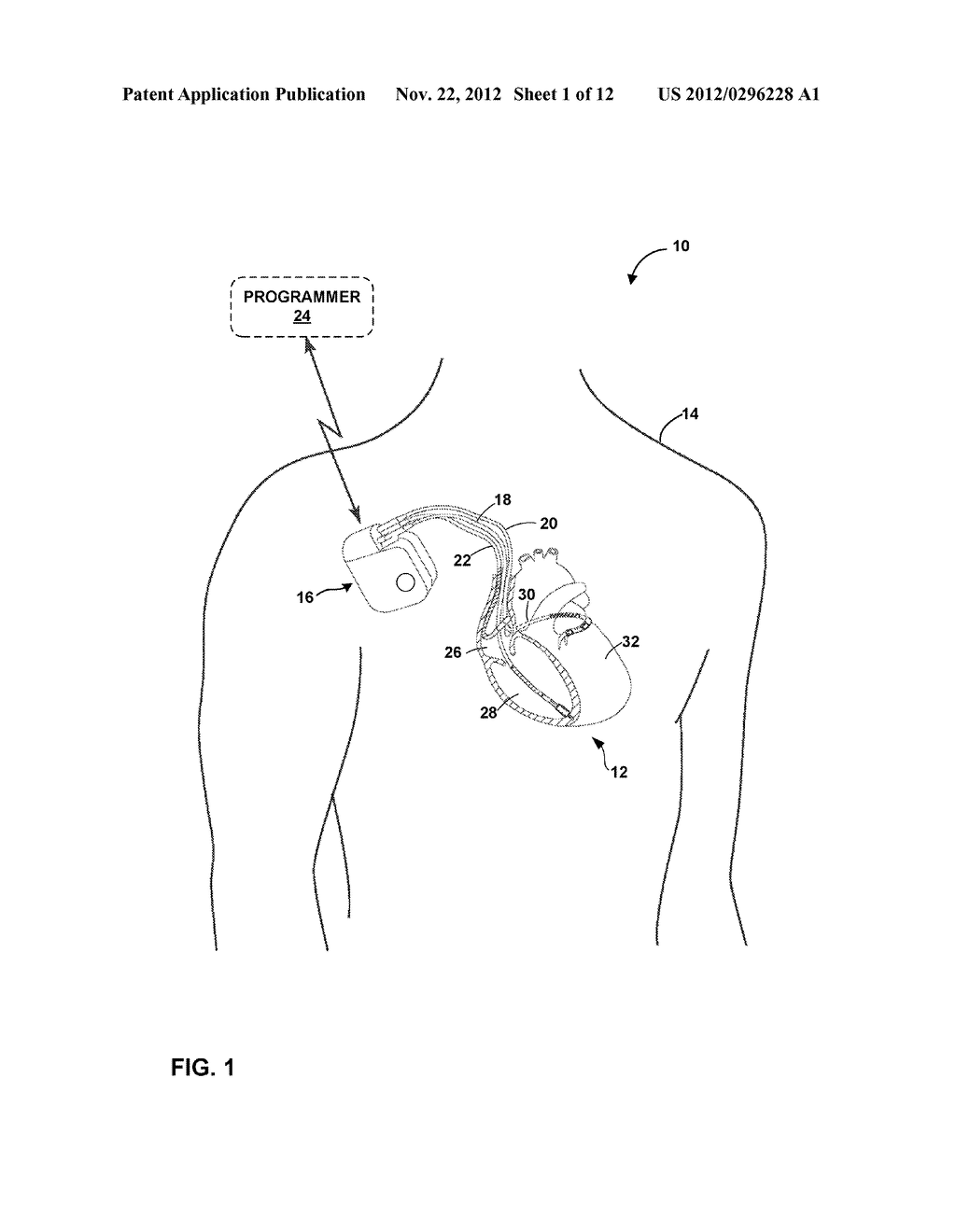 HEART SOUNDS-BASED PACING OPTIMIZATION - diagram, schematic, and image 02