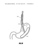 METHODS AND DEVICES FOR INTRAGASTRIC SUPPORT OF FUNCTIONAL OR PROSTHETIC     GASTROINTESTINAL DEVICES diagram and image