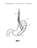 METHODS AND DEVICES FOR INTRAGASTRIC SUPPORT OF FUNCTIONAL OR PROSTHETIC     GASTROINTESTINAL DEVICES diagram and image