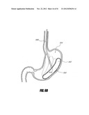 METHODS AND DEVICES FOR INTRAGASTRIC SUPPORT OF FUNCTIONAL OR PROSTHETIC     GASTROINTESTINAL DEVICES diagram and image