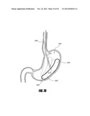 METHODS AND DEVICES FOR INTRAGASTRIC SUPPORT OF FUNCTIONAL OR PROSTHETIC     GASTROINTESTINAL DEVICES diagram and image