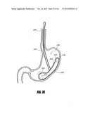 METHODS AND DEVICES FOR INTRAGASTRIC SUPPORT OF FUNCTIONAL OR PROSTHETIC     GASTROINTESTINAL DEVICES diagram and image