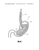 METHODS AND DEVICES FOR INTRAGASTRIC SUPPORT OF FUNCTIONAL OR PROSTHETIC     GASTROINTESTINAL DEVICES diagram and image